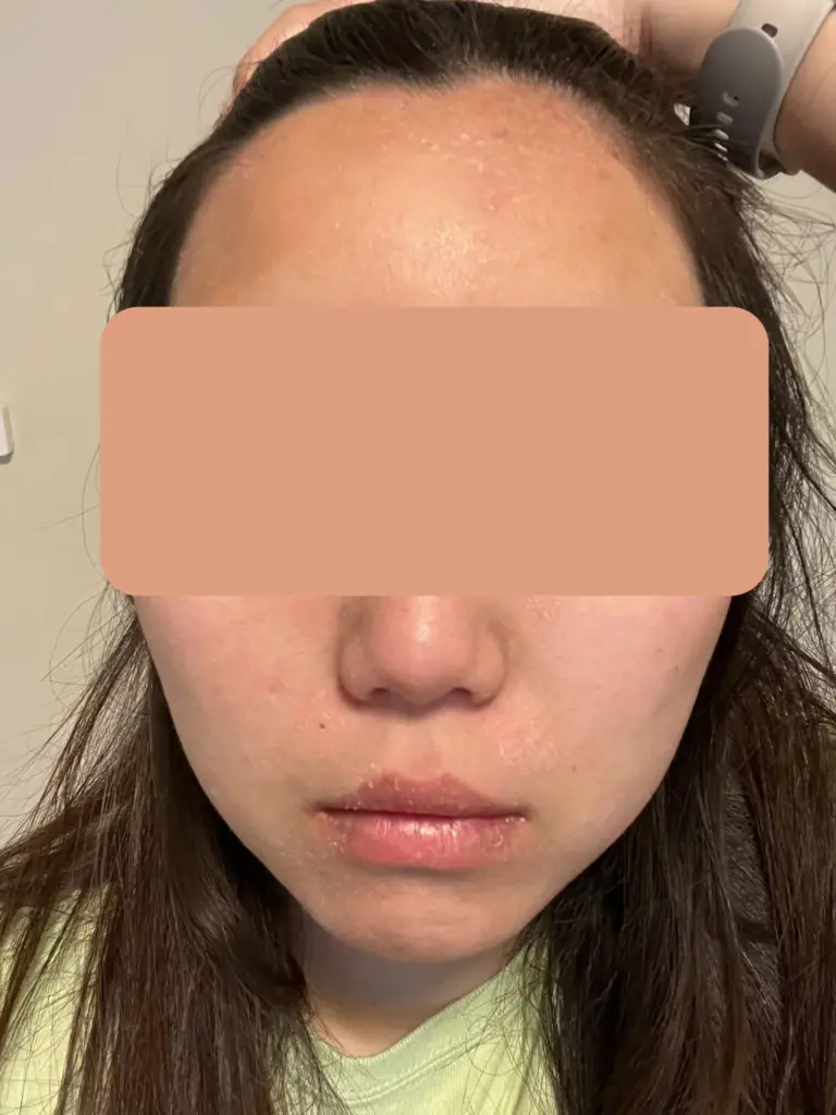 カナダ留学で人生最大に肌が荒れた【写真注意】