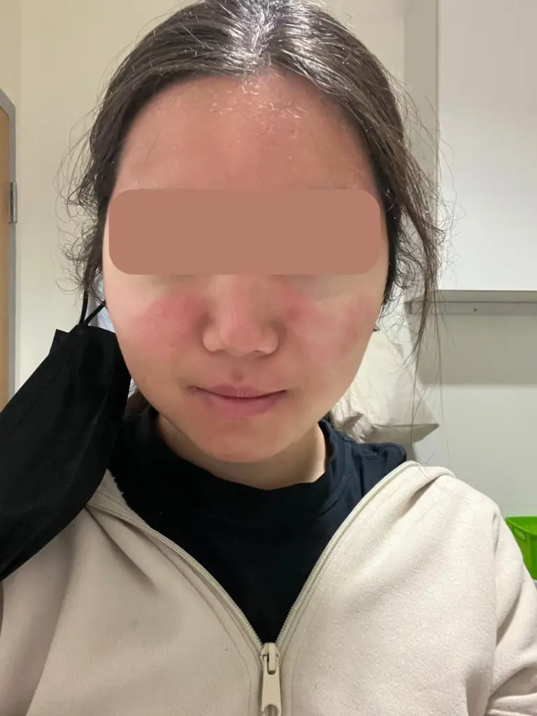 カナダ留学で肌が荒れたらどうする？【対処法】